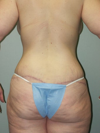 Belt Lipectomy and Breast Lift