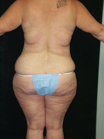Belt Lipectomy