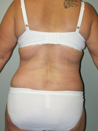Belt Lipectomy