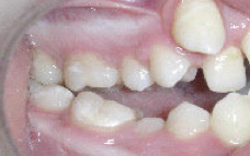 Damon Braces