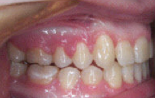 Damon Braces