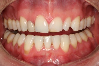 Tooth replacement in the smile