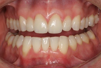 Tooth replacement in the smile