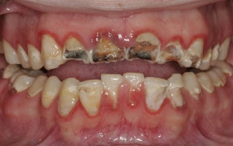 Full Mouth Reconstruction