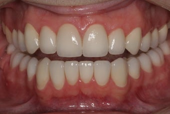 Full Mouth Reconstruction