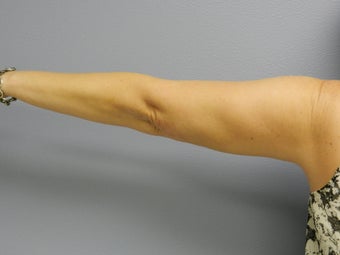Before Laser Lipo / Arms