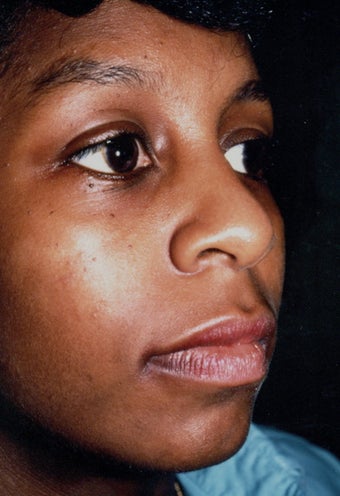 Rhinoplasty