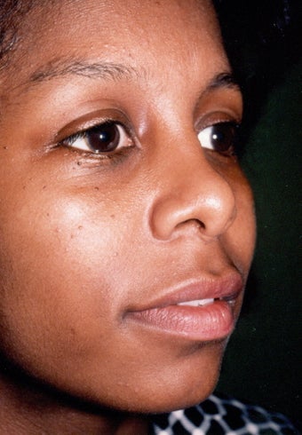 Rhinoplasty