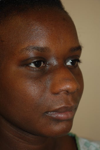 Rhinoplasty