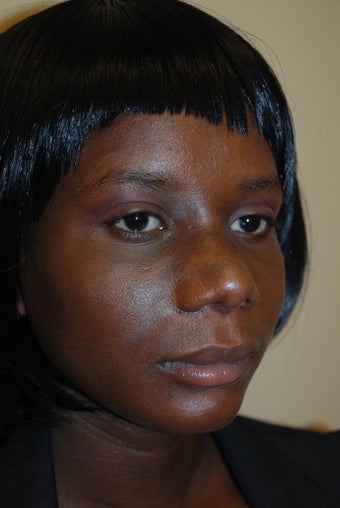 Rhinoplasty