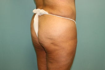 Brazilian Butt Lift
