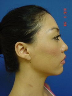 Chin Augmentation/rhinoplasty