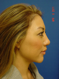Chin Augmentation/rhinoplasty