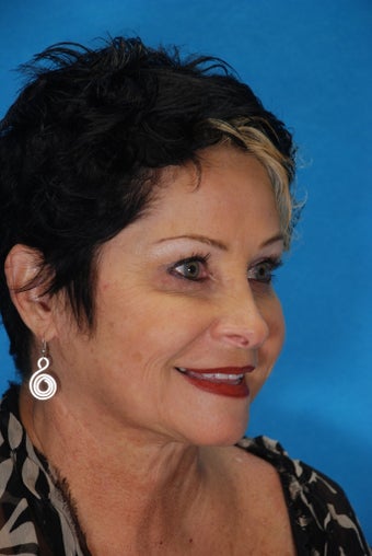 Botox and Juvederm