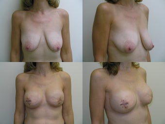 Bilateral Breast Reconstruction with Implants and Allograft