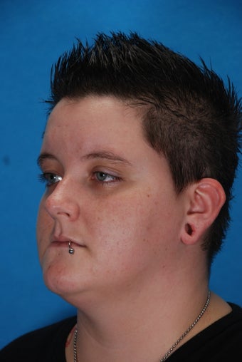 Ear Lobe Reconstruction