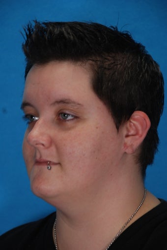 Ear Lobe Reconstruction