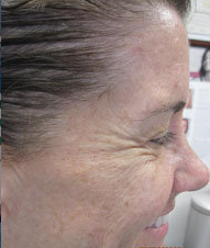 Botox
