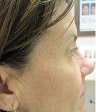 Botox