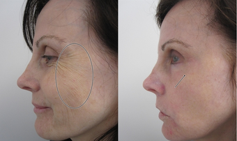 SmartXide Fractional CO2 Resurfacing