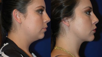 Liposuction of neck with chin implant