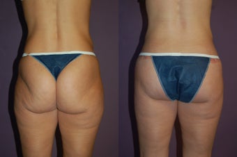 Butt Lift