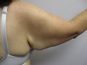 Arm Lift