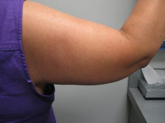 Arm Lift