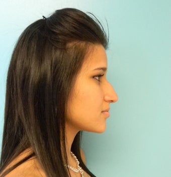 Rhinoplasty- Nose Job