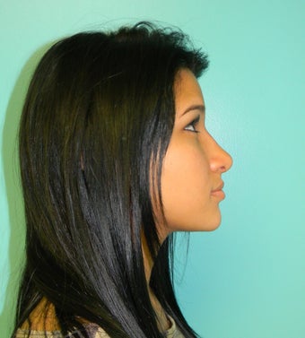 Rhinoplasty- Nose Job