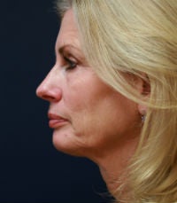 facelift