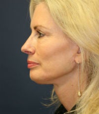 facelift