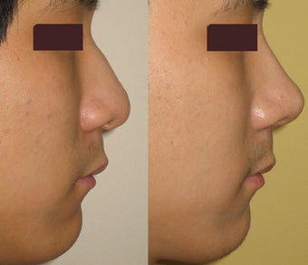 Rhinoplasty