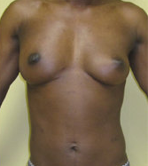 Brest Reconstruction With Natural Fat