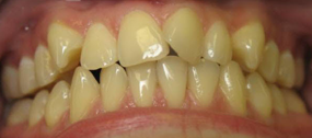 Invisalign