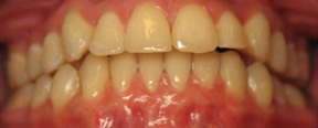Invisalign