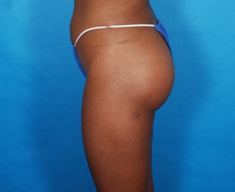 Buttock Implants