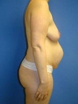 Breast Augmentation Mastopexy and Abdominoplasty