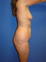 Breast Augmentation Liposuction and Abdominoplasty