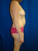 Breast Augmentation Mastopexy and Abdominoplasty