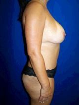 Breast Augmentation and Abdominoplasty
