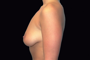 Breast augmentation and vertical mastopexy