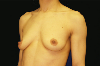 breast augmentation and mastopexy