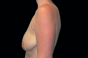 Breast augmentation