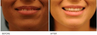 Upper Lip Reduction for Traumatic Lip Deformity