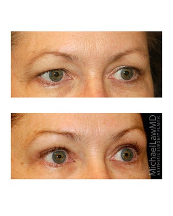 Brow lift