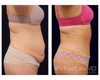 Tummy Tuck with Liposuction