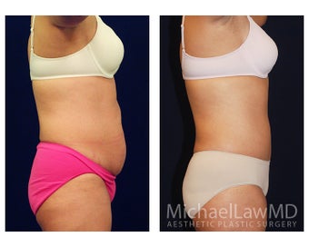 Tummy Tuck with Liposuction