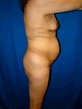 Breast Enhancement, ExtendedTummy Tuck (Abdominoplasty), Mommy Makeover