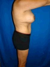 Breast Enhancement, ExtendedTummy Tuck (Abdominoplasty), Mommy Makeover